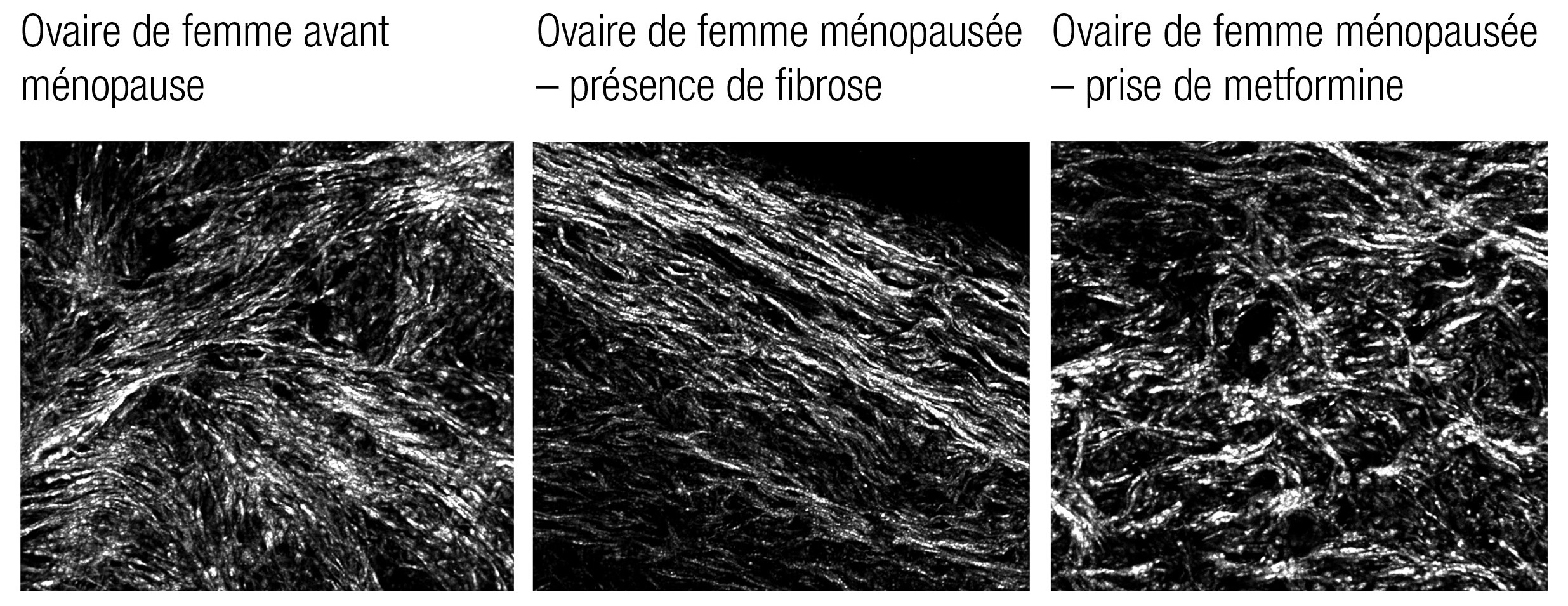 Selon les observations de chercheurs, la fibrose des ovaires (fibres parallèles lisses dans l’image centrale) survient avec l’âge. L’équipe de recherche a conclu que les ovaires de femmes ménopausées qui prennent de la metformine, un médicament contre le diabète, ne présentaient pas de fibrose.